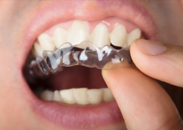 ceramic teeth braces